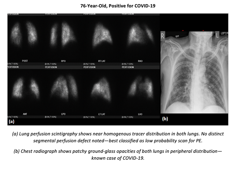 ARRS 2022: Perfusion Alone is Sufficient to Evaluate Acute Pulmonary Embolism in COVID Era