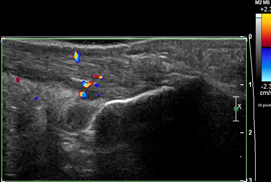 RSNA 2019: Image-guided retrocalcaneal bursa steroid injections significantly reduce heel pain