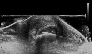 RSNA 2019: Image-guided retrocalcaneal bursa steroid injections significantly reduce heel pain