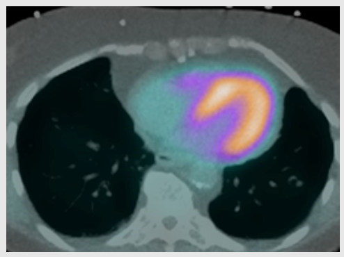 Guidelines Issued for Use of CT in Hybrid Nuclear-CT Cardiac Imaging