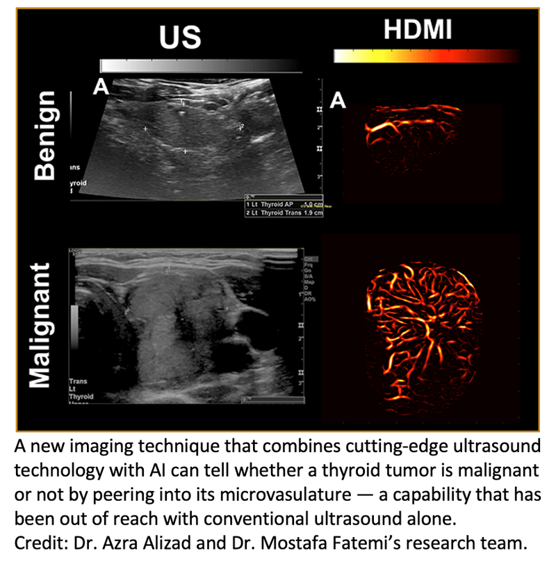 Advanced Ultrasound Paired With AI Can Diagnose Thyroid Cancers