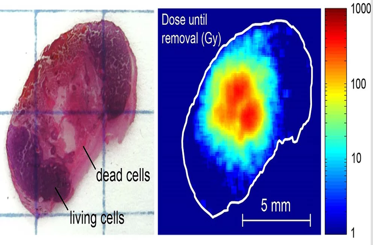 Alpha DaRT Receives Breakthrough Device Designation from the FDA