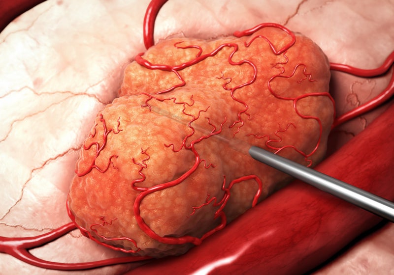Patient Enrollment Complete for DaRT Clinical Trial in Japan