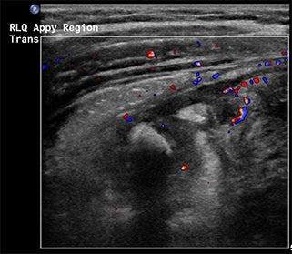 Secondary signs in equivocal ultrasounds improve diagnostic accuracy of appendicitis