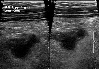 Secondary signs in equivocal ultrasounds improve diagnostic accuracy of appendicitis