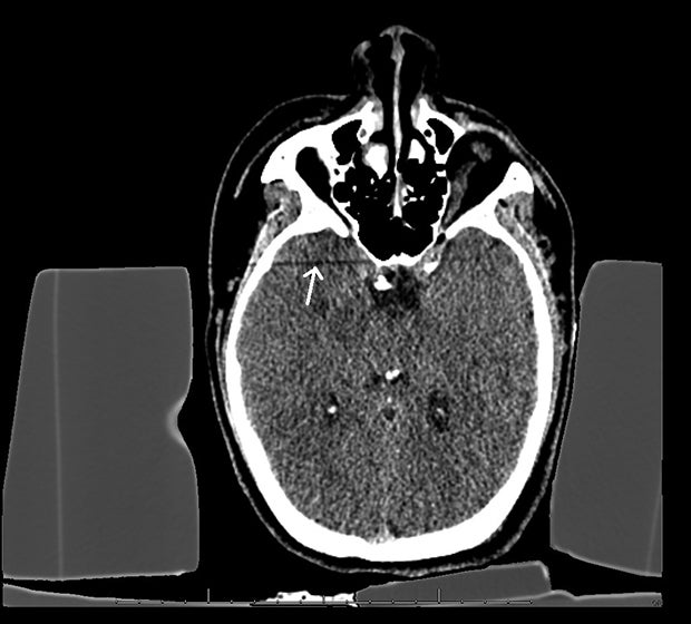 Even new spine immobilization devices create artifacts on CT images