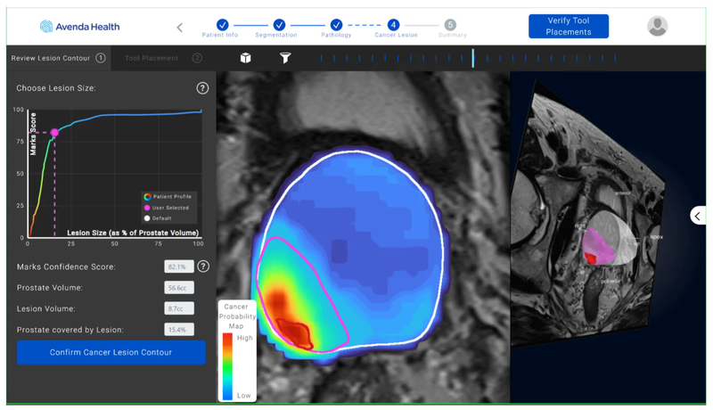 AI-Powered Prostate Cancer Precision Oncology Platform Receives FDA Clearance