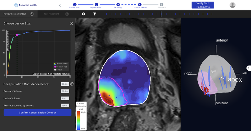 Clinicians Predict Extracapsular Disease Extension More Precisely With AI-Powered Tool