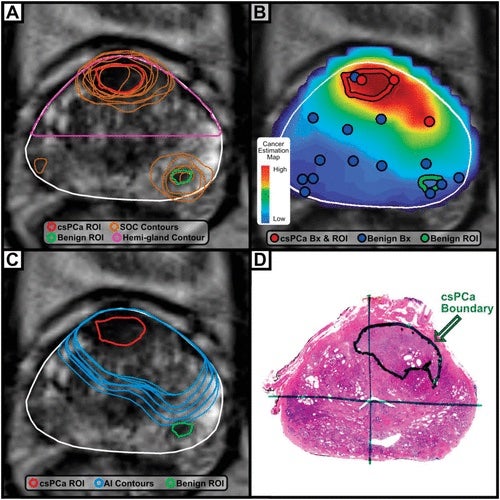 CMS Establishes National Payment for Innovative Prostate Cancer Mapping Technology