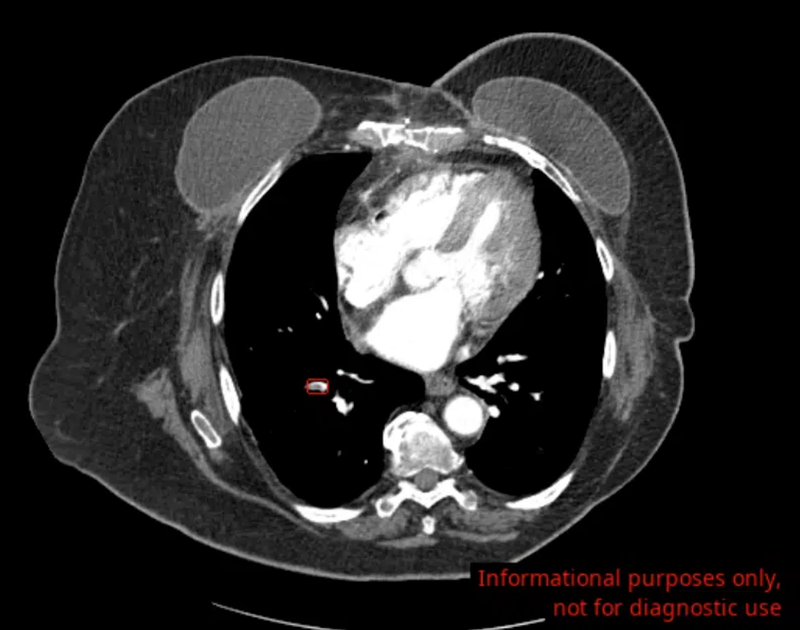 AI Tool for Incidental Pulmonary Embolism Detection Launched