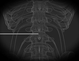 RSNA 2018: CT-guided pulsed radiofrequency brings long-term relief of chronic back pain