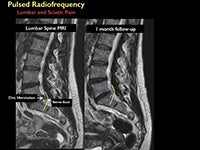 RSNA 2018: CT-guided pulsed radiofrequency brings long-term relief of chronic back pain