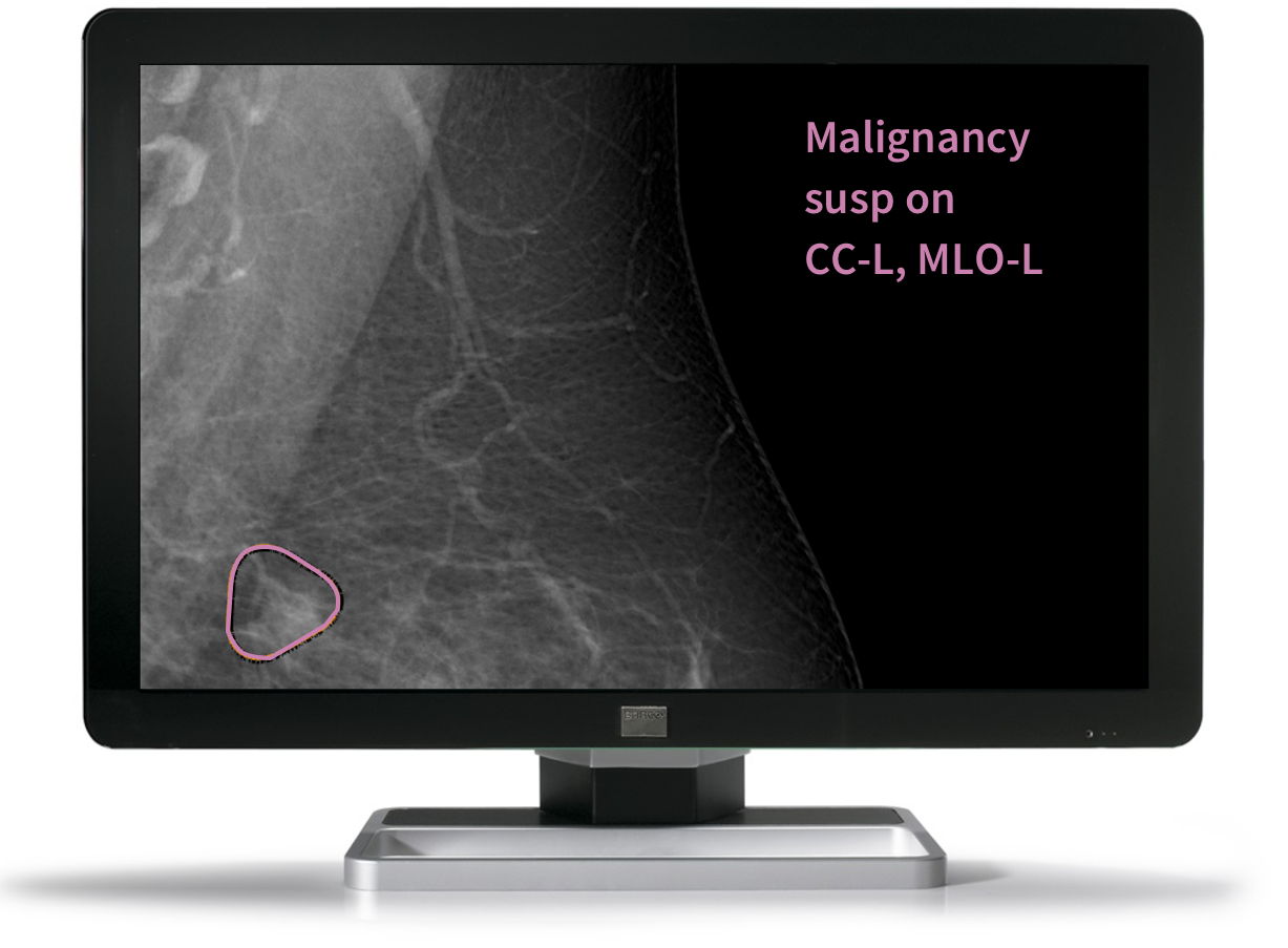 Kheiron Medical launches AI breast cancer screening software at ECR
