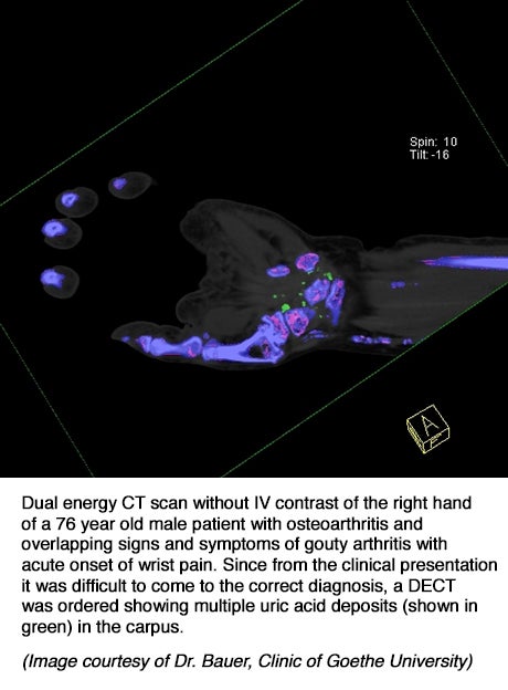 Dual-energy CT significantly contributes to treatment of rheumatic diseases
