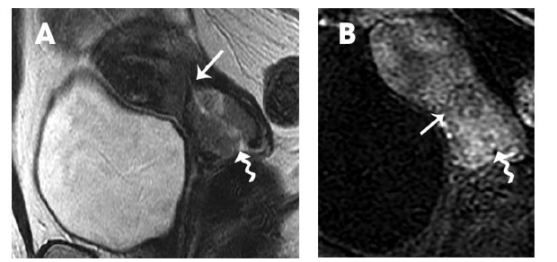 MRI suitable for trachelectomy treatment planning for cervical cancer patients