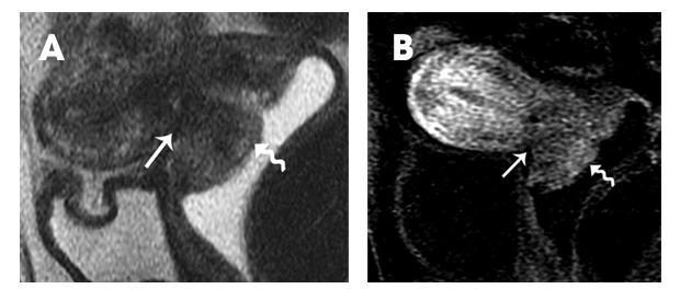 MRI suitable for trachelectomy treatment planning for cervical cancer patients