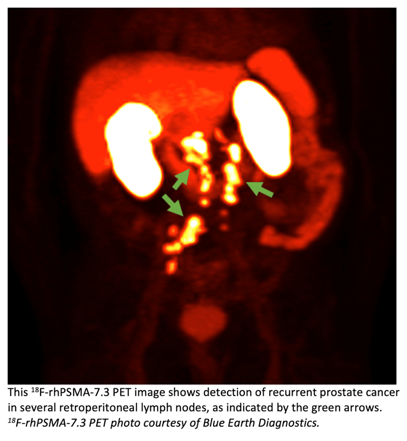 Additional Results of Phase 3 SPOTLIGHT Trial of PET Imaging Trial Reported at AUA 2023