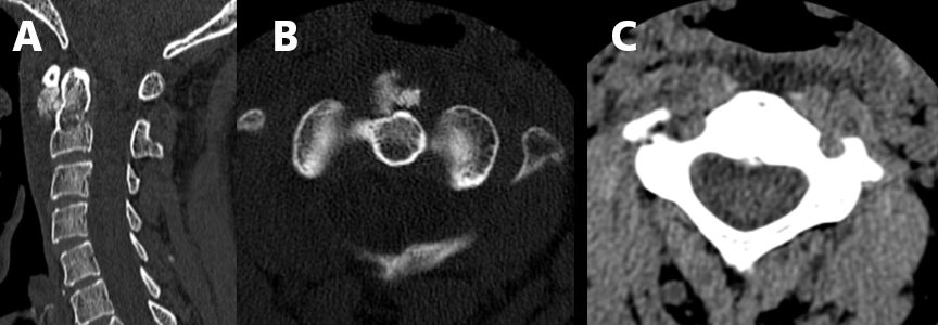 Identifying acute longus colli tendinitis on CT
