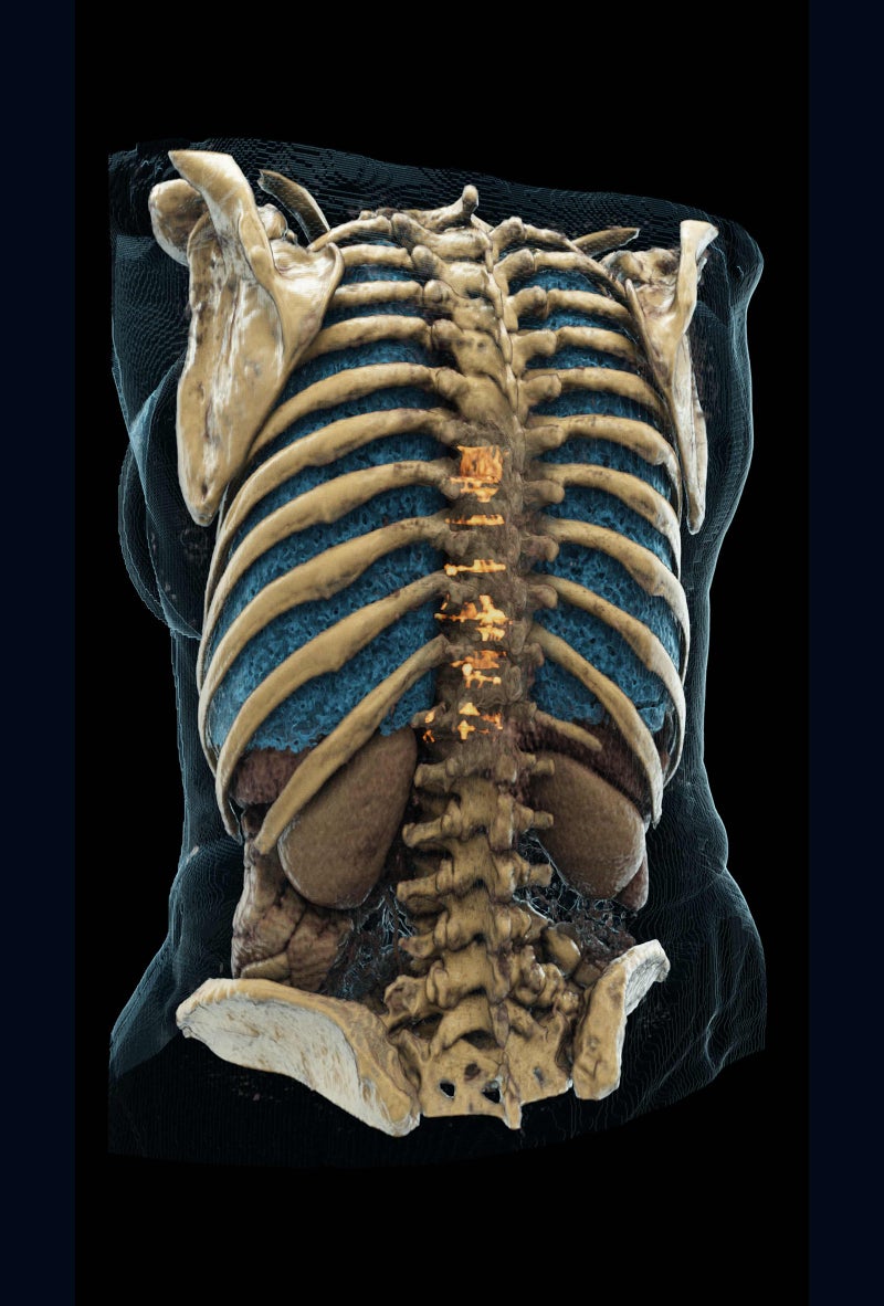 ASTRO Publishes Guideline on Radiation Therapy for Bone Metastases