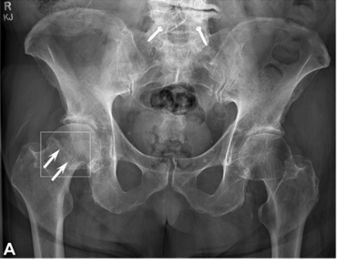 AI Software to Detect and Localize Fractures Gets FDA Nod