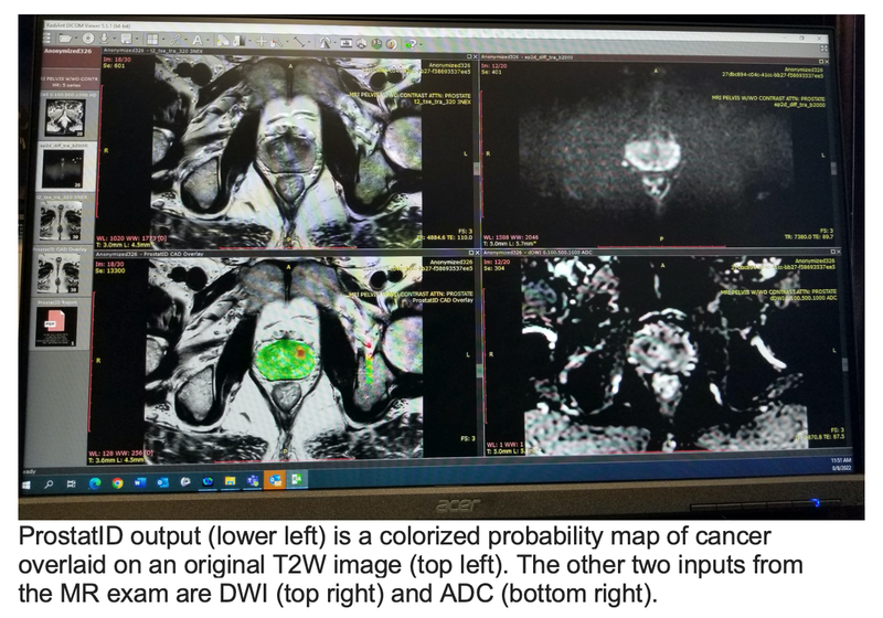 FDA Clears AI Software for MRI-Based Prostate Diagnosis