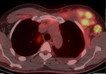 Practice Guideline for FES PET Imaging of Breast Cancer Published