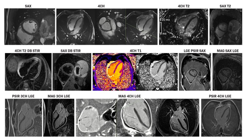 Clinical Applications of Gadopiclenol in Cardiac MRI