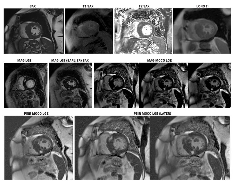Clinical Applications of Gadopiclenol in Cardiac MRI