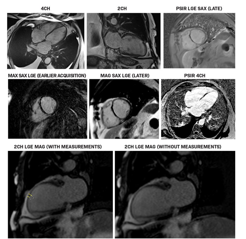Clinical Applications of Gadopiclenol in Cardiac MRI