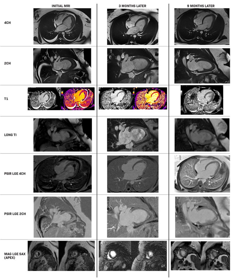 Clinical Applications of Gadopiclenol in Cardiac MRI