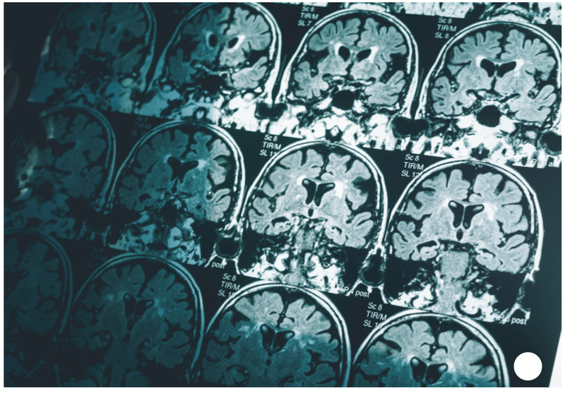 Fewer Surveillance MRIs for Incidental Pituitary Lesions Are Safe