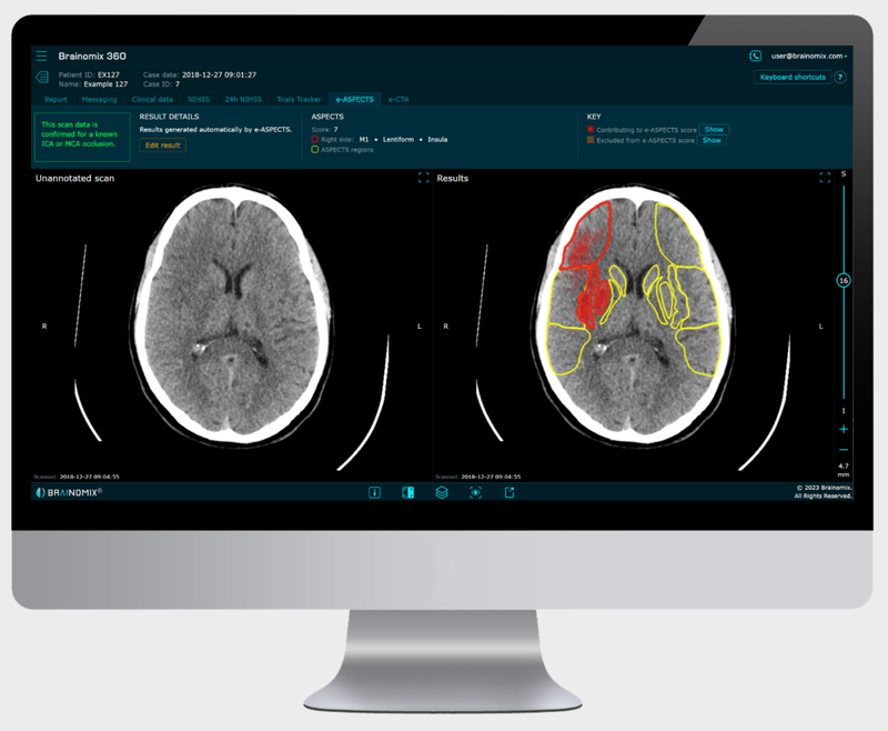 FDA Clears Stroke AI Imaging Software