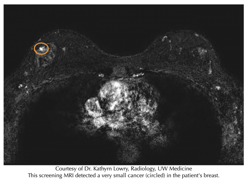MRI Screening Could Reduce Breast Cancer Deaths from Variants in Three Genes