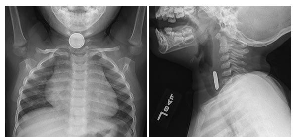 Button battery ingestions and diagnostic imaging