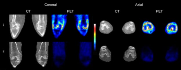 Evaluating rheumatoid arthritis with PET