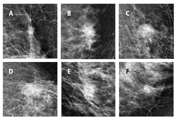 Prototype deep learning CAD to detect breast lesions reaching mammographer’s performance