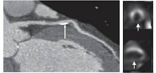 Increased Coronary Plaque Activity Detected With PET/CT Tied to Greater Risk for Myocardial Infarction