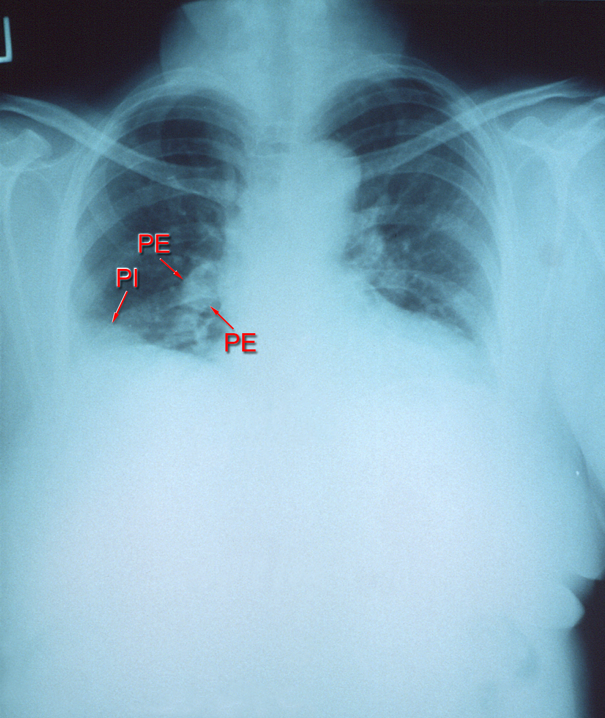 Viz.aI and Avicenna.AI Collaborate on Pulmonary Embolism, Aortic Disease Care Coordination