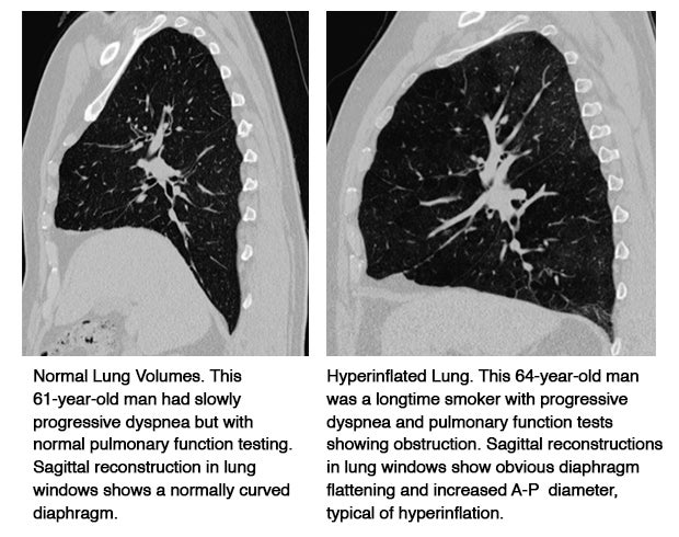 Sagittal reconstruction improves identification of COPD by CT