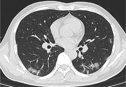 AJR Review: CT Not Substantiated for COVID-19 Diagnosis