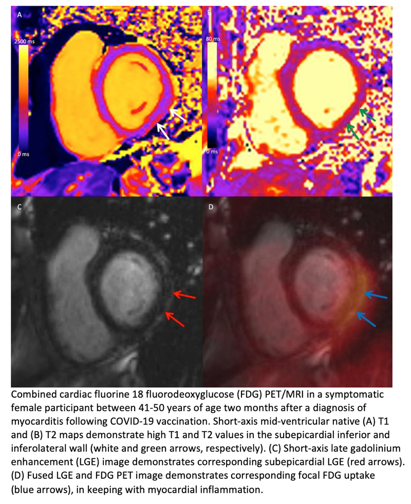 Heart Inflammation After COVID Vaccine Found Only in Patients With Acute Myocarditis