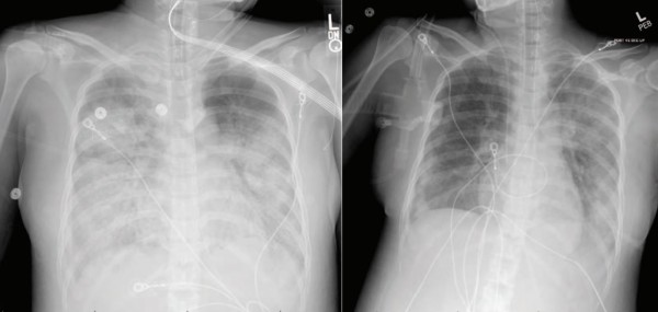 UC Davis: Lessons Improve COVID-19 Insight, Prompt CDC Screening Updates