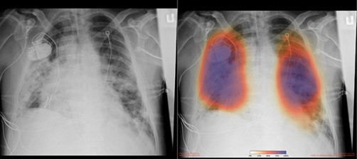 AI Enables Rapid COVID-19 Lung Imaging Analysis at UC San Diego Health