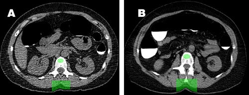 Automated CT tool assesses bone mineral density