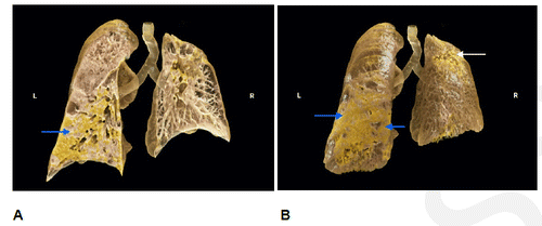 New Images Show CT Cinematic Rendering of SARS-CoV-2 Pneumonia