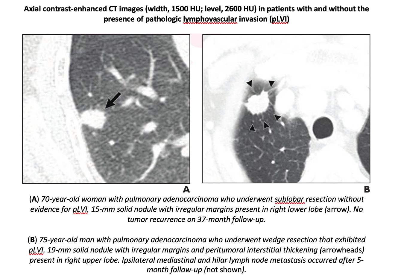 CT may Help Identify Candidates for Sublobar Resection in Early-Stage Non-Small Cell Lung Cancer