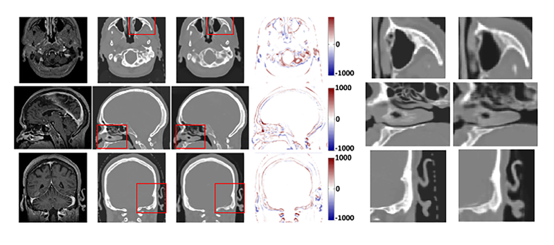 Synthetic CT: Realizing the Benefits of MR-Based Treatment Planning