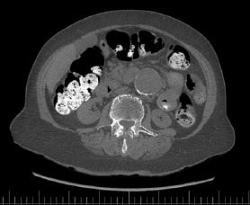 CT colonography: A screening exam for abdominal aortic aneurysms
