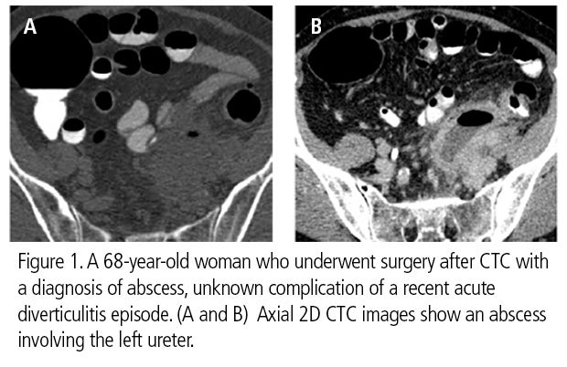 CT colonography recommended to follow patients after acute diverticulitis episode