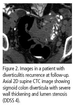 CT colonography recommended to follow patients after acute diverticulitis episode